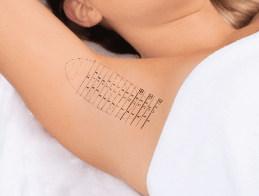 A temporary tattoo used to mark skin for treatment preparation.