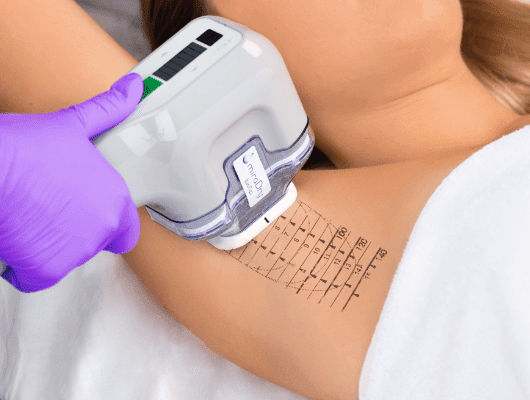 A specialist performing the miraDry treatment procedure on a patient.